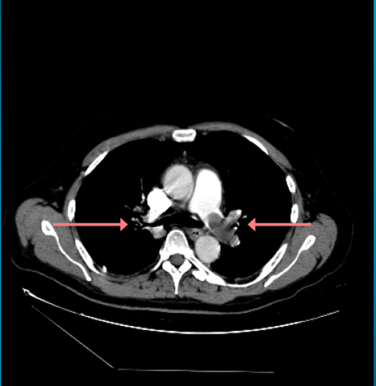 Pulmoner Tromboemboli (Akciğer Damarlarında Pıhtı)
